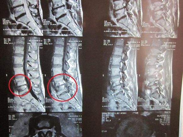 Gimdos kaklelio osteochondrozės diagnozė