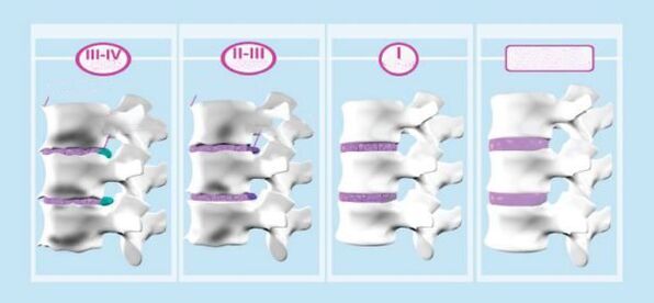Gimdos kaklelio osteochondrozės etapai