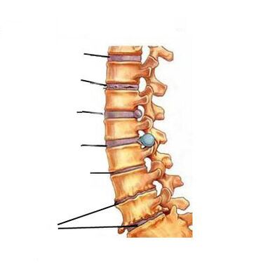 Kaip išsivysto osteochondrozė
