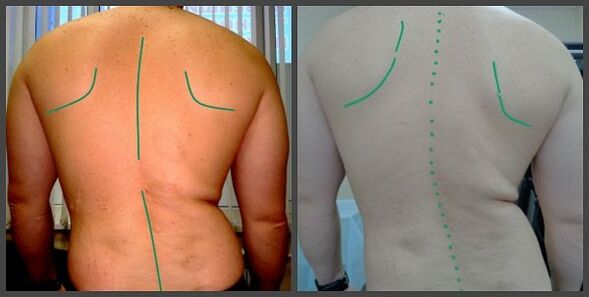 Stuburo kreivumas su osteochondroze