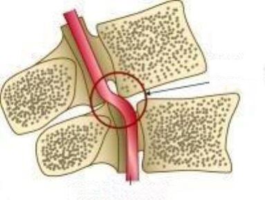 Vail arterijos sindromas