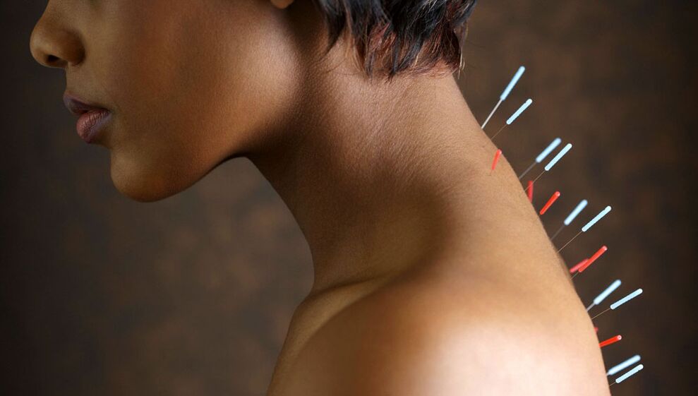 akupunktūra su gimdos kaklelio osteochondroze