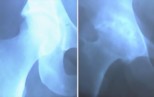 Kelio sąnario artrozės plunksna