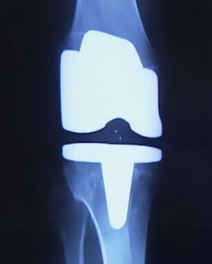 X -kelio vaizdas su dirbtiniu protezu po operacijos, kad pakeistumėte jungtį