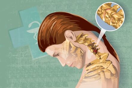 Reflekso simptomai osteochondrozės simptomai